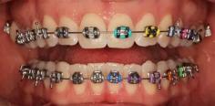 Are you looking for the Best Metal Braces in Boon Keng? Then contact them at Absolute Family Dental is based in Boon Keng, Singapore.  Visit - https://maps.app.goo.gl/Jh5xeeSThTdLsSdQ7.