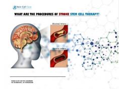 Stroke stem cell therapy is a life saving option for those people who are suffering from this condition. 