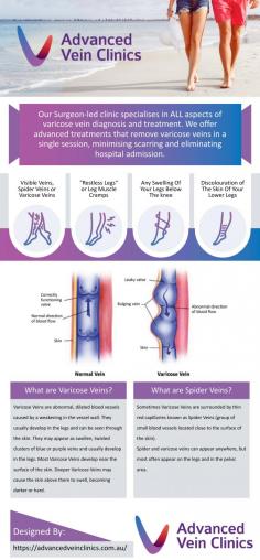 Do you suffer from Visible veins, Spider veins or Varicose veins? "Restless Legs" or leg muscle cramps? Any swelling of your legs below the knee? Discolouration of the skin of your lower legs? Advanced Vein Clinics may be able to help. Our Sydney-based clinic specialises in ALL aspects of varicose vein diagnosis and treatment. Our surgeon-lead team offers advanced treatments that remove varicose veins in a single session, minimising scarring and eliminating hospital admission. Our aim? Healthy legs that look great!