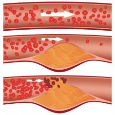 If you’ve heard the term "claudication" during a medical consultation, you may be wondering, “What are the symptoms of claudication?” Leg claudication is one of the most common symptoms of peripheral artery disease.