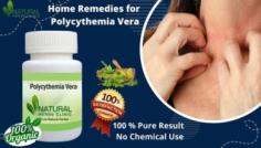 Polycythemia is a long-lasting condition and does not have any process of treatment or says it can’t be cured. Though, experts are of the opinion that intake of Natural Treatment for Polycythemia Vera could help in thinning of blood and preventing blood clots. But natural herbal remedies for Polycythemia Vera are effective to form reducing the major symptoms.
