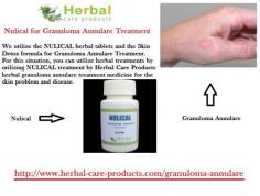 In very widespread cases the treatment of granuloma Annulare may be tired. Natural Remedies for Granuloma Annulare, a chronic rash with red bumps include apple cider vinegar, Avocado Paste, Virgin Coconut Oil, Vitamin E, Green Tea, Green Tea, Herbal Oils Ginger Margosa and Milk of Magnesia. Some Herbal Treatment for Granuloma Annulare is given below.