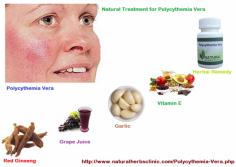 Below are natural Herbal Remedies for Polycythemia Vera that are used to treat this disease properly. Because Polycythemia Vera deals with the blood cell count, enhance in cancer risk, and interfere with bone marrow production, the following herbs directly get better these problems. Polycythemia Vera Herbal Treatment including garlic and cayenne aid in thinning the blood and preventing blood clots. Additionally, certain lifestyle measures are helpful treatment options.
