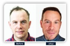 We provide the most advanced and best hair loss treatments for male at Ailesbury Hair Clinic. Our friendly team specializes in creating unique ways to help you regain your confidence and hair. You can rely on Ailesbury Hair Clinic to provide you with the best possible results, whether it's through non-surgical treatments or advanced hair transplant techniques. Book an appointment for your consultation right now to start along the path to healthier, fuller hair.
https://www.ailesburyhairclinic.ie/hair-loss/