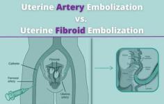 Uterine Artery Embolization: Fast Recovery, Lasting Results

Are you searching for a minimally invasive treatment for uterine fibroids? Uterine Artery Embolization (UAE) could be the solution you’ve been waiting for. UAE is a non-surgical procedure that effectively targets the blood supply feeding fibroids, causing them to shrink and alleviate symptoms like heavy bleeding, pelvic pain, and pressure. Compared to traditional surgeries, UAE offers a faster recovery, minimal scarring, and no need for general anesthesia. At USA Fibroid Centers, our experienced specialists use advanced techniques to ensure a safe and comfortable experience. Don't let fibroids control your life—find out how uterine artery embolization can help you regain control and improve your quality of life. Our team is dedicated to guiding you through every step of your treatment journey.
Schedule your consultation today and take the first step towards fibroid relief with uterine artery embolization!
Visit- https://www.usafibroidcenters.com/blog/uterine-artery-embolization-vs-uterine-fibroid-embolization/ 