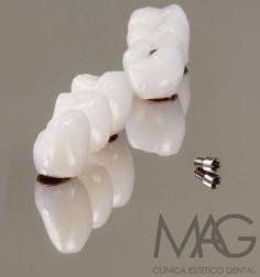 Descubre los precios asequibles de los implantes dentales en Magdental en Madrid. Nuestro equipo de expertos ofrece implantes de máxima calidad con atención personalizada, garantizando resultados duraderos y naturales. Obtén un presupuesto detallado y recupera tu sonrisa hoy mismo. Programa tu consulta para conocer más sobre nuestros precios de implantes dentales.