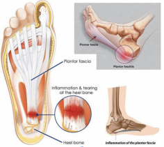 Plantar fasciitis can be a real showstopper. Whether you’re an athlete, someone who spends long hours on their feet, or simply going about your daily routine, stabbing heel pain can quickly put a damper on life. At ADAPT Recharge, a 1-on-1 physical therapy and chiropractic clinic focused on mobility training and manual therapy, we’ve seen firsthand how frustrating and limiting this condition can be. In this blog, we’ll break down what plantar fasciitis is, what might be causing it, and—most importantly—share actionable steps you can take right now to start feeling relief. Plus, we’ll explain how our specialized approach at ADAPT Recharge can help you recover and regain full mobility.