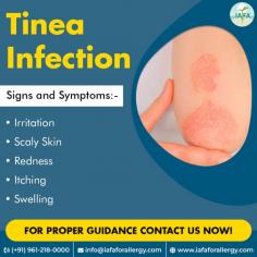 Common Signs and Symptoms of Tinea Infection