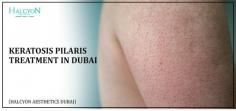 Transform your skin with professional Keratosis Pilaris Treatment in Dubai at Halcyon Aesthetics. Led by Dr. OBT, we provide the Best Keratosis Pilaris Treatment using innovative techniques for long-lasting results. Schedule your consultation today!