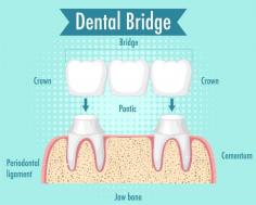 Urgentdent offers affordable bridges & crowns near you in Munster or Merrillville. Restore chipped, cracked, or missing teeth for a beautiful smile. Call us now!

https://urgentdent.com/treatment/bridges-and-crowns/