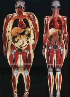 Body scan of 250 pound woman and 130 pound woman. If this isn't motivation to work out, I don't know what is!! Check out the fat around the heart & brain and the difference in sizes of the stomach and intestine. Also, the knee joints. I wish there was one that wasn't quite as big so it could be a bit more realistic to compare but this is still something to think about.  I needed to see this. Yikes