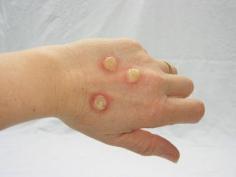 cut out a few circles from bubble wrap. Stick double sided tape to the back of them. Stick 'em to your hands and face. Use a bit of face paint or makeup to make them pus coloured and finally a little red lipstick blended around the edges to create inflamed skin. so gross.