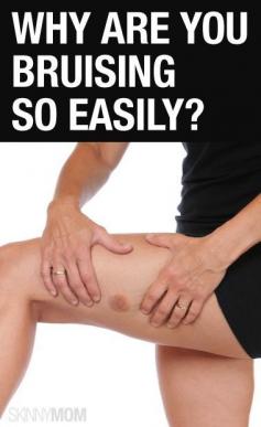 
                    
                        Find out why you may be bruising so easily.
                    
                