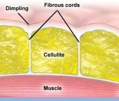As fat cells enlarge, they push up against the skin. Tough, long connective cords pull down. This creates an uneven surface or dimpling, often referred to as cellulite.