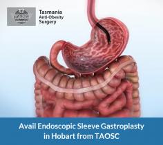 Endoscopic Sleeve Gastroplasty (ESG) is an endoscopic procedure that significantly reduced risks and more rapid recovery. At Tasmania Anti-Obesity Surgery, we help obese people to reduce the weight with this most effective surgery.