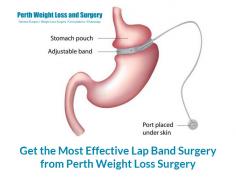 Achieve the weight loss goals with Perth Weight Loss Surgery’s lap band surgery. In this surgery, a silicon-based device called band is placed around the top of the stomach to restrict food intake. It is an adjustable band that can suit an individual’s requirements.