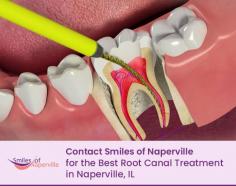 Want to save your teeth before getting infected? Call the experienced dentists if Smiles of Naperville for the best root canal treatment. This procedure will help you save your teeth with proper care. 