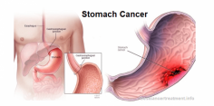 Stomach cancer - Types, Symptoms, Causes, Stages, Treatment