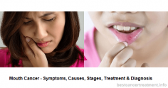 Mouth Cancer - Symptoms, Causes, Stages, Treatment & Diagnosis