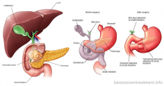 Pancreatic cancer - Causes, Symptoms, Stages, Treatment, Types