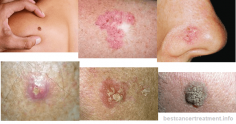 Skin Cancer - Causes, Symptoms, Treatment & Types
