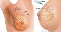 Breast Cancer - Types, Symptoms, Causes, Stages, Treatment