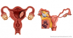 Uterine Cancer - Types, Symptoms, Causes, Stages, Treatment