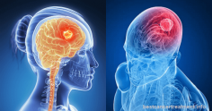 Brain Cancer - Types, Symptoms, Causes, Stages, Treatment