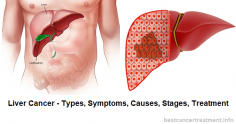 Liver Cancer - Types, Symptoms, Causes, Stages, Treatment