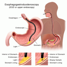 Upper endoscopy (EGD)

Upper endoscopy is the examination of the lining of the upper part of your gastrointestinal tract that includes esophagus, stomach and duodenum (beginning of your small intestine) using a thin, flexible tube called endoscope which has a video camera and a light source. For more details please visit at http://sripathikethumd.com/procedures/upper-endoscopy-egd/