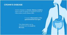 Crohn’s disease is chronic inflammation of the lining of the digestive tract, most commonly affecting the end of the small intestine (the ileum) where it joins the beginning of the colon.