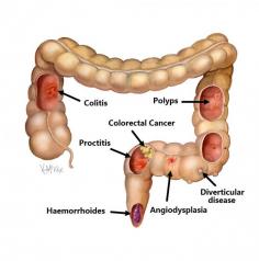 Rectal bleeding - Sripathi Kethu, M.D.

The 2 most common reasons for the rectal bleeding are hemorrhoids and anal fissure. For more details, please visit at http://sripathikethumd.com/symptoms/rectal-bleeding/