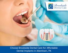 Dental implants in Allentown, PA from Brookside Dental Care is an excellent solution to replace your missing teeth. We offer dental implants that look and function like natural teeth. Get in touch today!