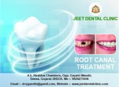 Dr. Jaimin Gandhi provides affordable treatment for root canal in Deesa, India, at low cost. We have most experienced dentists for root canal treatment

 Call at ￼+91 9824273056 or visit us at jeetdentalclinic.com to book a Appointment with us.
https://jeetdentalclinic.com