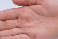 Dr. Saif Fatteh is a trusted Wart Removal Specialist serving Mt. Pleasant & East Lansing, MI. Our dermatologists can address your particular case with minimally invasive and safe techniques in order to remove your warts.