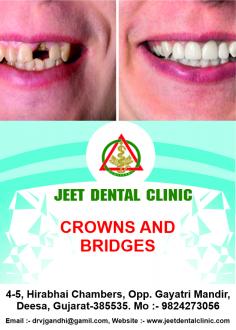 Expert  Replacement of Missing teeth in Deesa
  
Replacement of missing teeth with dental implants......
Best treatment option for replacement of missing teeth in Deesa. Call at ￼+91 9824273056 or visit us at jeetdentalclinic.com to book a Appointment with us.
