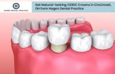 At Hagen Dental Practice, we use CEREC technology, which gives a perfectly fitting crown in only one visit. We have been using CEREC technology for many years to help our patients bring the smile back on their faces.