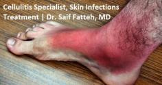 Cellulitis is a bacterial infection of the skin that can cause redness, itching, pain, and swelling. If you’re concerned about cellulitis or other common skin issues like boils, viral infections, or abscesses, Get in touch with Dr Dr. Saif Fatteh, MD. 