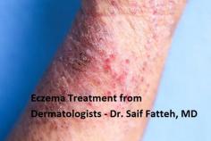Eczema treatment from leading dermatologists in Mt. Pleasant at Safe Health Center. We provide personalised treatment to address your specific eczema condition. If you’re hoping to find an effective plan for managing your eczema, book an appointment with Dr. Fatteh today. 
