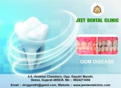 Did you ever have the feeling that people have avoided talking to you face to face? There is bleeding while you brush? Teeth that are sensitive to hot or cold? Gum disease is best service in Deesa. Call at ￼+91 9824273056 or visit us at jeetdentalclinic.com to book a Appointment with us.