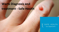 For your specialized wart removal in Mt. Pleasant & East Lansing, MI, choose the experts of Safe Health Clinic of Dermatology Clinic. We are experienced in the various types of warts, whether it is plantar warts, Plane warts or Filiform warts. Our general dermatologists can properly diagnose your specific type of wart and provide customized treatment for both pediatric and adult patients. 