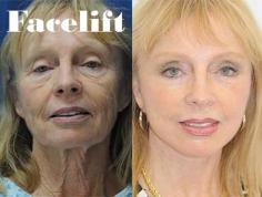 Facelifts are one of our most popular services here at Kansas Plastic Surgery. A facelift, also known as a rhytidectomy, typically treats skin laxity and wrinkles around the face and the neck.