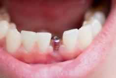 Immediately Loaded dental implants