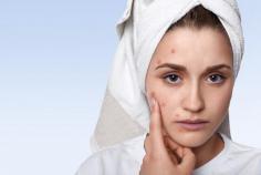 As you already know oily and acne-prone skin is sensitive, being aware of the habits that can irritate your skin may be the key to keep things looking good and clear. Read on to discover some of the essential things that may make your acne worse, so you will know exactly what to avoid for healthy and beautiful skin. - http://safe-health-pc.over-blog.com/2020/08/4-surprising-things-you-should-avoid-if-you-have-acne.html