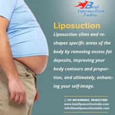 Liposuction is a cosmetic procedure that removes fat that you can’t seem to get rid of through diet and exercise.
Success of surgery, to a great extent, depends on the surgeon you have chosen. Make sure you consult board certified surgeon who has years of experience and expertise in performing liposuction surgery.  You will also get to know the exact liposuction surgery cost in Delhi only after consulting a surgeon.
Call \ Whatsapp on +91-92899 88888, 9958221983
Get more https://www.bestliposuctionindia.com
#liposuction #vaserliposuction #bodyjetliposuction #cosmeticsurgery #plasticsurgeon #bodycontouring #Delhi #India #drkashyap
