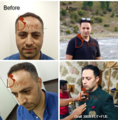 The patient is highly happy with his own hair transplant result that treated by Dr. Amit Gupta. Visit us at https://www.divinecosmeticsurgery.com/
