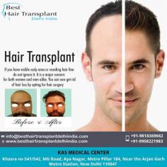 Hair Transplant: If you have visible scalp area or receding hair line, do not ignore it. It is a major concern for both women and men alike. You can now get rid of hair loss by opting for hair surgery in India.
https://www.besthairtransplantdelhiindia.com
Call / Whatsapp TODAY - 91 9818369662, 9958221982, 9958221981
Now New Address: Khasra no 541/542, MG Road, Aya Nagar, Metro Pillar 184, Near the Arjan Garh Metro Station, New Delhi 110047 (India)
#FUEHairTransplant #HairTransplantation #HairTreatment #Eyebrow #Eyelash #Beard #Moustaches #CosmeticSurgery #CosmeticSurgeon #PlasticSurgery #PlasticSurgeon #MedSpa #DrAjayaKashyap #DrKashyap
