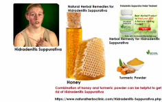 You can mix the pure honey with turmeric powder and apply it to the affected area it can be a very effective Natural Remedies for Hidradenitis Suppurativa. Apply for 30 minutes before washing it off.... https://www.naturalherbsclinic.com/blog/natural-remedies-for-hidradenitis-suppurativa/