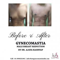 KAS medical Center has experienced surgeon and also have many years of experience in this field. If you are looking for the best gynecomastia surgery in Delhi then you can undoubtedly go with KAS Medical Center.
For more details visit: www.bestgynecomastiaindia.com
Call: +91-9818963662, +91-9958221981
Send Your Query: info@bestgynecomastiaindia.com
Now New Address: Khasra no 541/542, MG Road, Aya Nagar, Metro Pillar 184, Near the Arjan Garh Metro Station, New Delhi 110047 (India)
#gynecomastia #malebreastreduction #cosmeticsurgery #plasticsurgeon #gynecomastiaclinic #Drkashyap #Delhi #India
