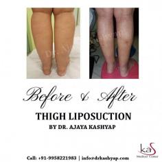 KAS medical Center has experienced surgeon and also have many years of experience in this field. If you are looking for the Thigh Liposuction Surgery in Delhi then you can undoubtedly go with KAS medical Center.
Contact Dr. Kashyap Clinc at +91-9958221983, 9958221982 to book a consultation.
Visit: https://www.drkashyap.com/
Now New Address: Khasra no 541/542, MG Road, Aya Nagar, Metro Pillar 184, Near the Arjan Garh Metro Station, New Delhi 110047 (India)
#thighliposuction #liposuction #thigh #thighliposuctionindelhi #cosmeticsurgery #plasticsurgeonindia #drkashyap
